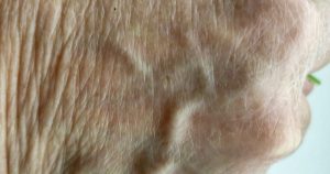 Kuvassa on käden selän ihoa. Oikealla pilkistää pieni vihreä viiva.