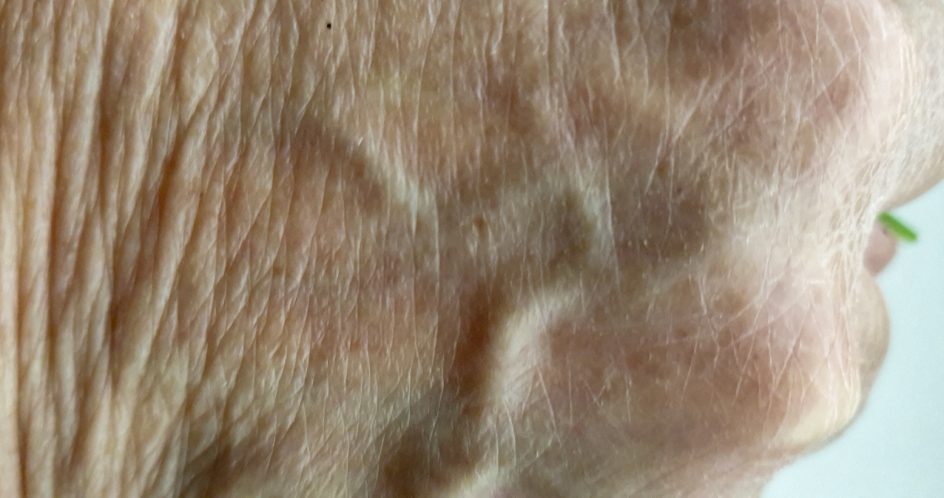 Kuvassa on käden selän ihoa. Oikealla pilkistää pieni vihreä viiva.