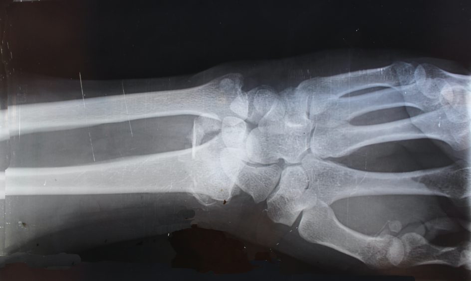 Röntgenkuva kädestä