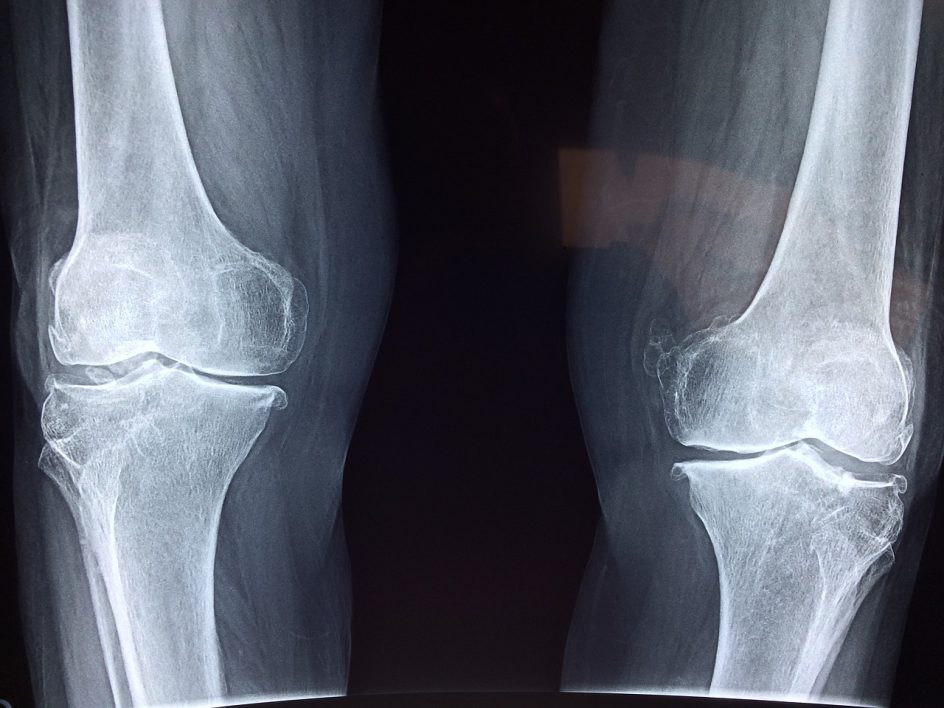 Röntgenkuva jaloista